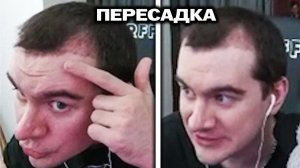 БРАТИШКИН ПОКАЗАЛ ПРОМЕЖУТОЧНЫЙ РЕЗУЛЬТАТ ПЕРЕСАДКИ ВОЛОС / СНЯЛ КЕПКУ НА СТРИМЕ