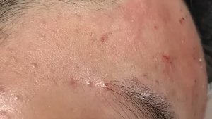 Удаление скрытых подкожных прыщей (закрытых комедонов), черных точек