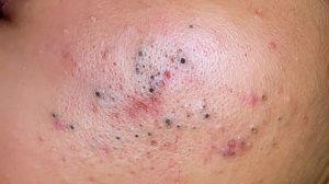 Blackhead Extraction [ASMR] Deep Pore Cleansing Routine (Oddly Satisfying)