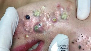 Экстремальное удаление черных точек: сатисфакция и релакс