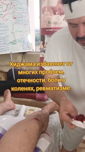 Хиджама избавляет от многих проблем, отечности, боли в коленях, ревматизме.
Олег Гудвин. #костоправ