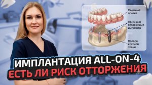 Имплантация All-on-4: есть ли риск отторжения и нужна ли костная пластика?