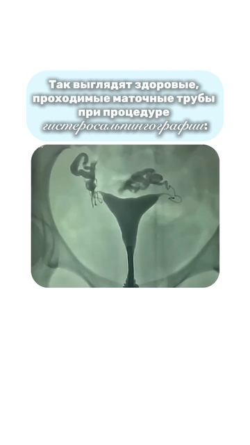 Часто спрашивают: «Доктор, а больно ли проверять проходимость маточных труб?»