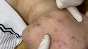 Множественные прыщи – профессиональная экстракция