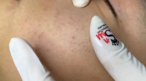 Acne collection • A040 • Архив SacDepSpa • АСМР