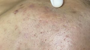 Чистка лица от акне на комбинированной коже
