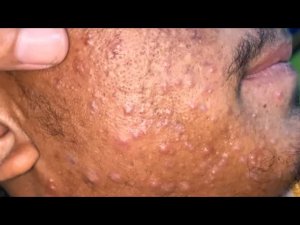 sac be spa face blackhead care for elderly men | skin care information new video 2027 | #333