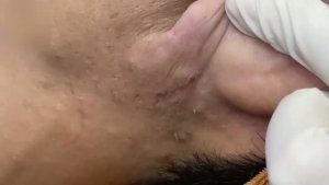 Скрытые прыщи на лице – экстракция