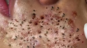 Extreme Blackhead Removal Satisfying Relaxing #1135