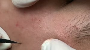 Результативная чистка кожи от прыщей и угрей