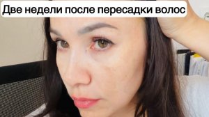 Вся правда о моей ПЕРЕСАДКЕ ВОЛОС в Турции