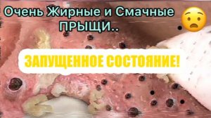 Выдавливание прыщей. НОВОЕ! Угри. Акне. чистка лица