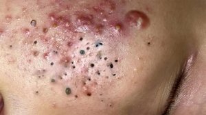 Экстремальное удаление чёрных точек: сатисфакция и расслабление