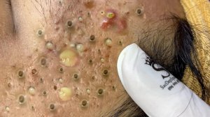 Extreme Blackhead Removal Satisfying Relaxing #1134