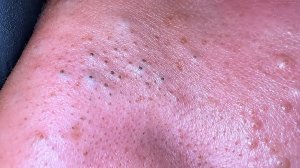 Extreme Blackhead Removal from Nose | asmr sleep & relax Korean Skincare Routine