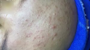 Удаление прыщей – профессиональная чистка кожи