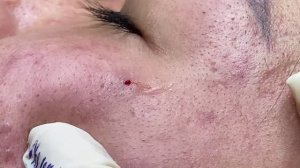 Глубокая чистка лица от акне и комедонов