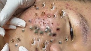 Выдавливание прыщей. НОВОЕ! Угри. Акне. чистка лица