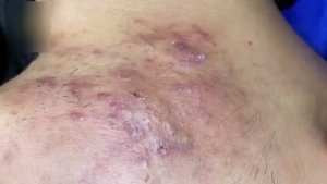 Комплексное удаление акне и черных точек