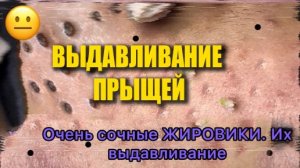 Выдавливание прыщей. НОВОЕ! Угри. Акне. чистка лица