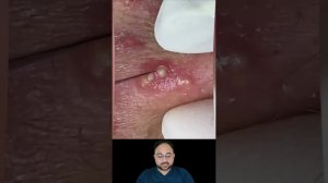 Супер сатисфакция: выдавливание прыщей 😱