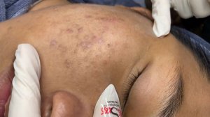 372 • Acne collection • АСМР • Relax Spa