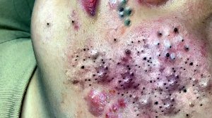 Выдавливание прыщей. НОВОЕ! Угри. Акне. чистка лица