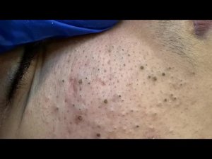 ASMR Satisfying Pimple Popping Experience: Deep Blackhead Removal and Facial Care