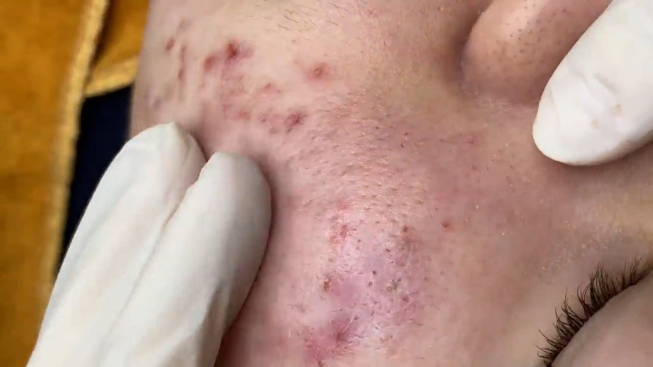 393 • Acne Collection • АСМР • Relax Spa
