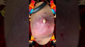 Satisfying self-cleaning of blackheads Acne Treatment Pimple pop