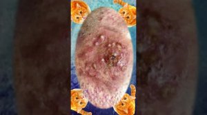 Satisfying self-cleaning of blackheads Acne Treatment Pimple pop