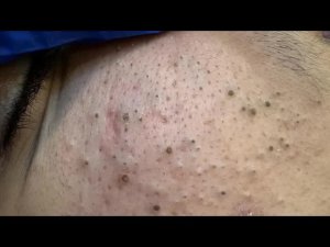 SATISFYING Deep Pore Cleansing & Blackhead Removal | Best Facial Care Routine for Oily Skin