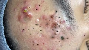 Экстремальное удаление черных точек: удовлетворение и расслабление