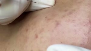 Удаление подкожных прыщей и чёрных точек
