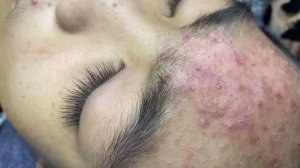 Безопасное удаление прыщей и комедонов