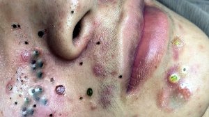 Выдавливание прыщей. НОВОЕ! Угри. Акне. чистка лица