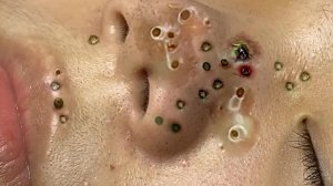 Экстремальное удаление черных точек: удовлетворение и релакс