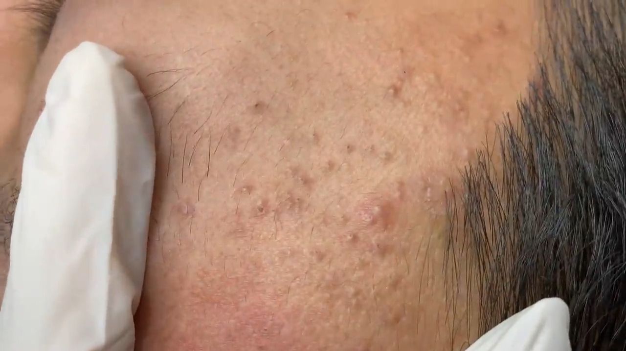 383 • Acne Collection • АСМР • Relax Spa
