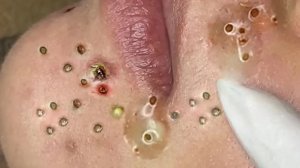 Extreme Blackhead Removal Satisfying Relaxing #1207