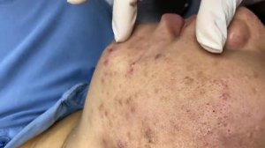 391 • Acne collection • АСМР • Relax Spa