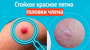 😡 Стойкое красное пятно головки члена. Клинический случай №1638