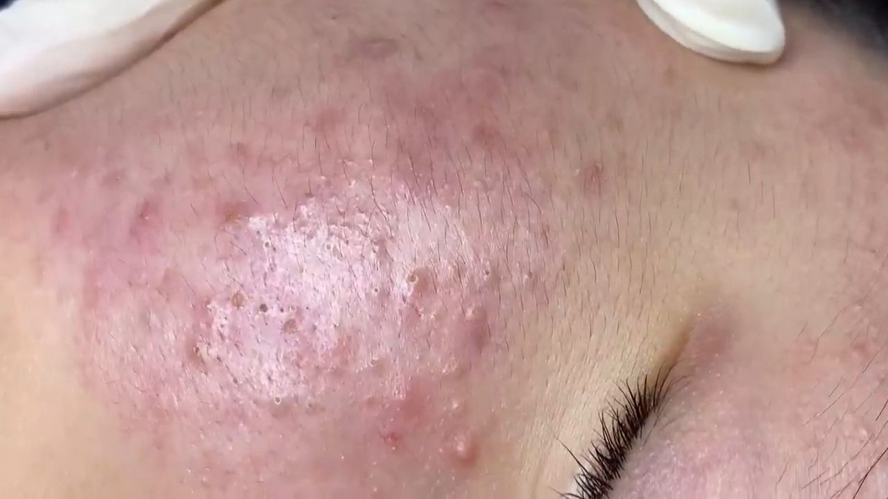 371 • Acne Collection • АСМР • Relax Spa