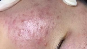 371 • Acne collection • АСМР • Relax Spa