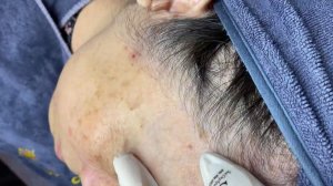 382 • Acne collection • АСМР • Relax Spa