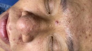 392 • Acne collection • АСМР • Relax Spa