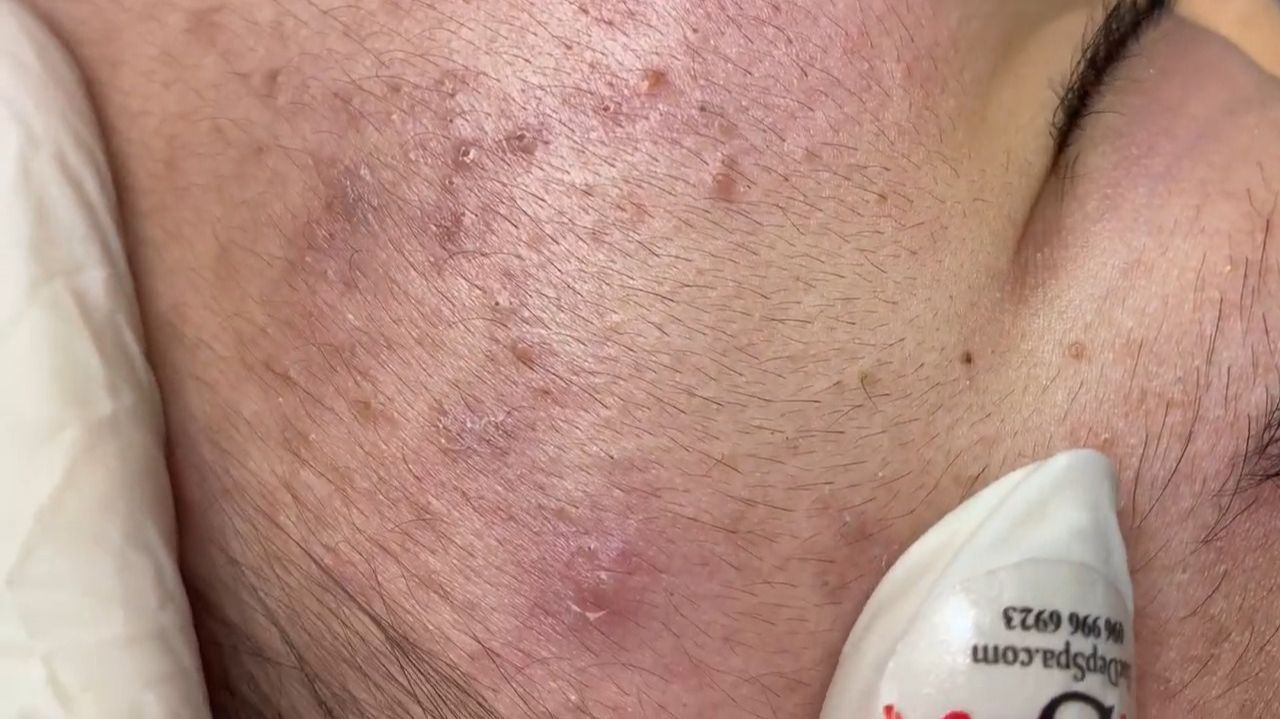 370 • Acne Collection • АСМР • Relax Spa
