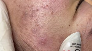 370 • Acne collection • АСМР • Relax Spa
