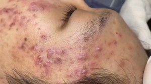 384 • Acne collection • АСМР • Relax Spa