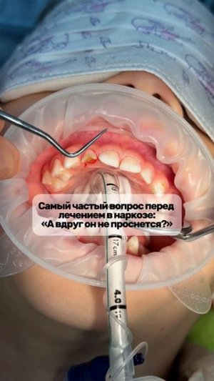 Лечение зубов в наркозе