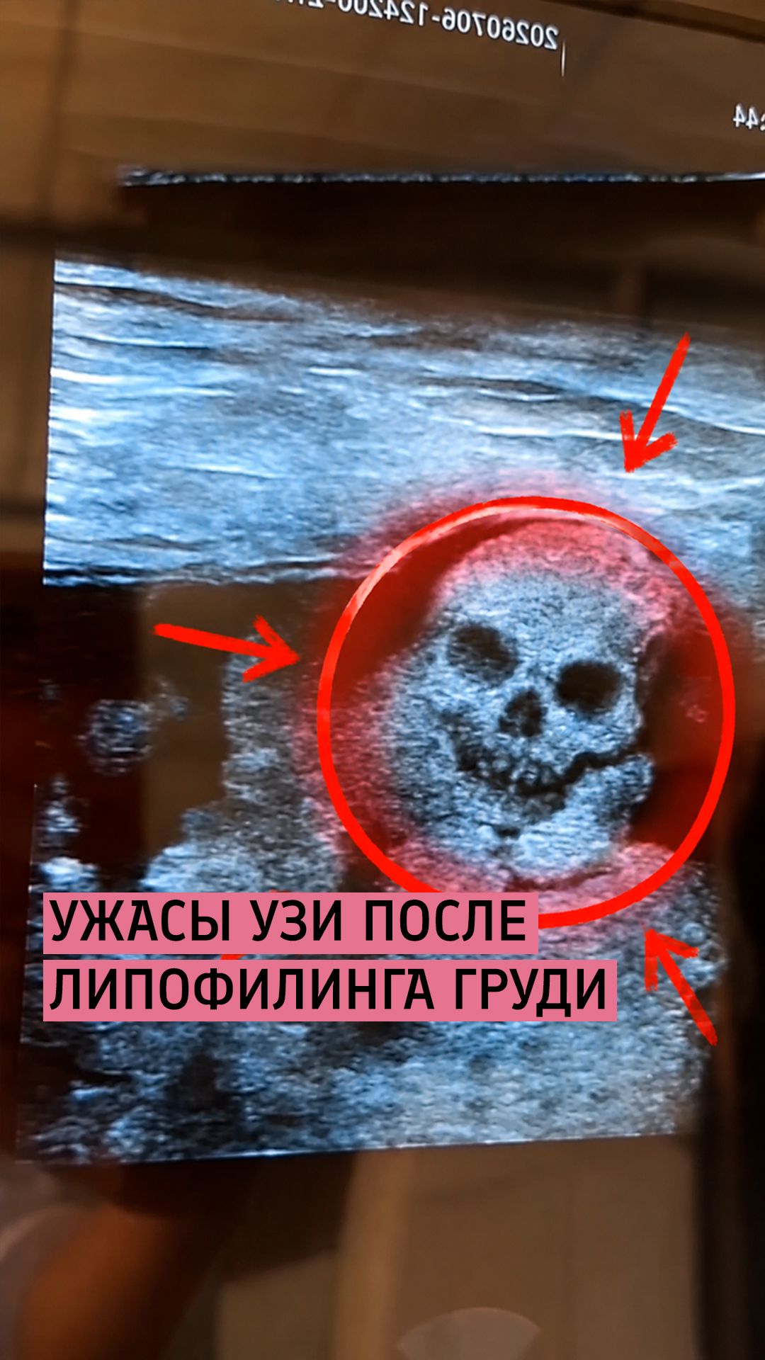 Чем опасен липофилинг груди? / Кисты и липогранулемы / Бурлова Мария Григорьевна